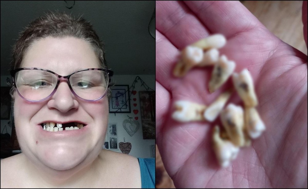 FOTO // O mamă şi-a scos singură 11 dinţi, pentru că nu avea bani să meargă la un dentist